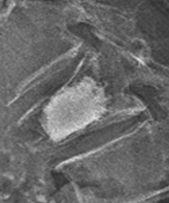 BKP(経皮的椎体形成術)2
