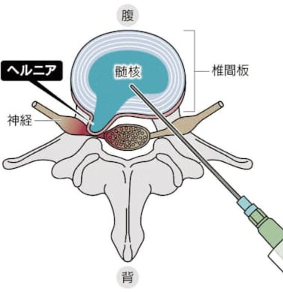 ヘルニコア4